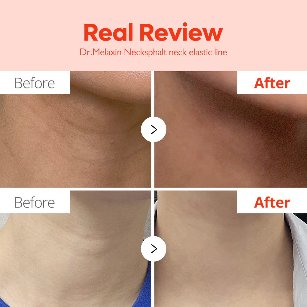 Necksphalt ECM Neck Tightening Line - Image 5